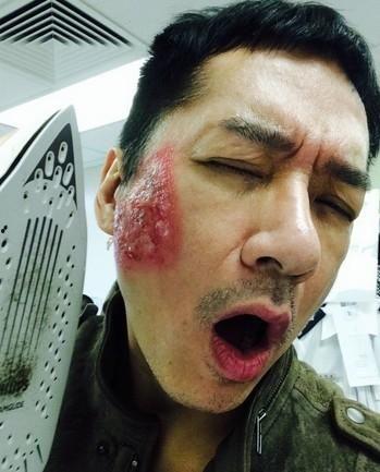 明星脸部烧伤,揭秘明星脸部烧伤的康复之路